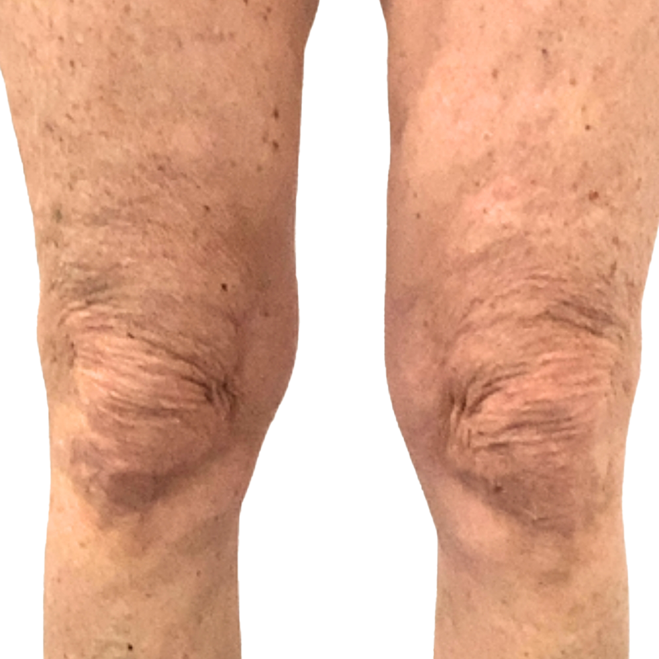 Patient 1 Legs & Knees_BEFORE ZSTIM & ZSHAPE SQUARE